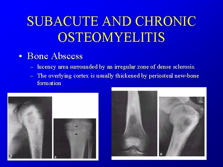 SUBACUTE AND CHRONIC OSTEOMYELITIS • Bone Abscess – lucency area surrounded by an irregular