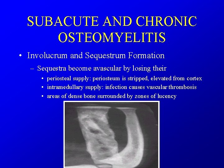 SUBACUTE AND CHRONIC OSTEOMYELITIS • Involucrum and Sequestrum Formation – Sequestra become avascular by