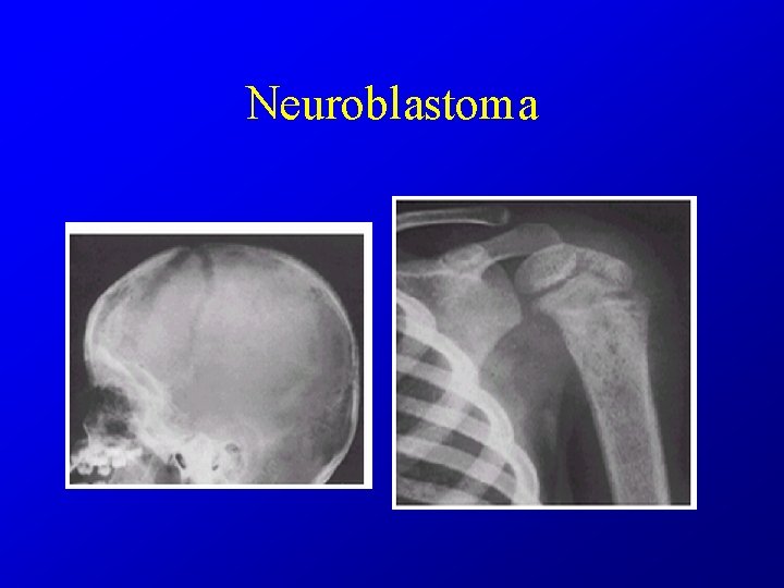 Neuroblastoma 