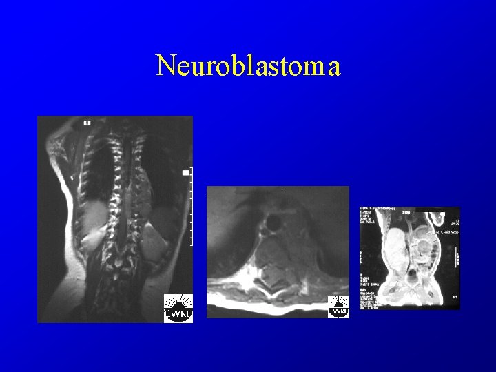 Neuroblastoma 