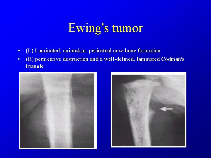 Ewing's tumor • (L) Laminated, onionskin, periosteal new-bone formation • (R) permeative destruction and