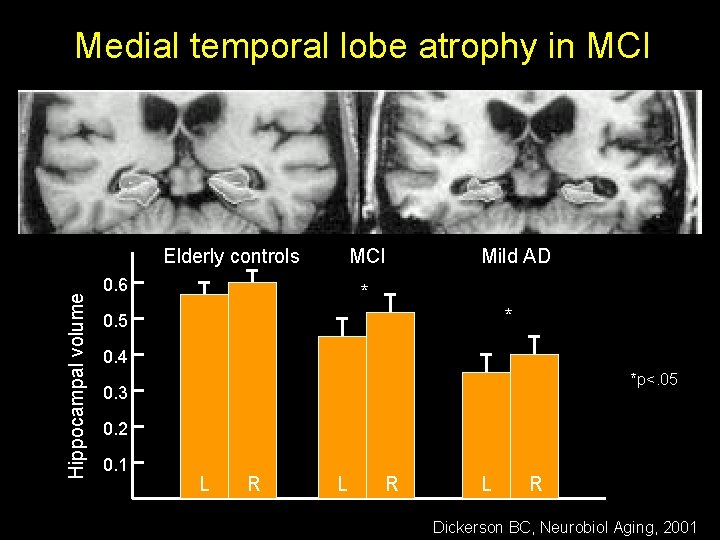 Medial temporal lobe atrophy in MCI Hippocampal volume Elderly controls MCI 0. 6 Mild