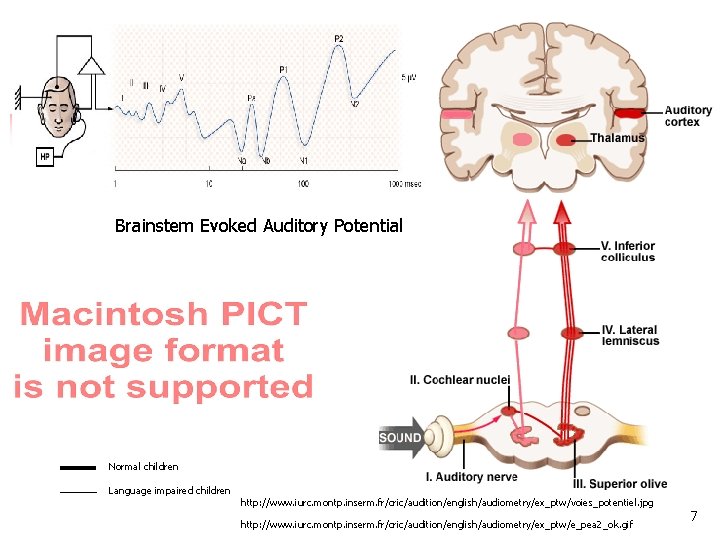 Brainstem Evoked Auditory Potential Normal children Language impaired children http: //www. iurc. montp. inserm.