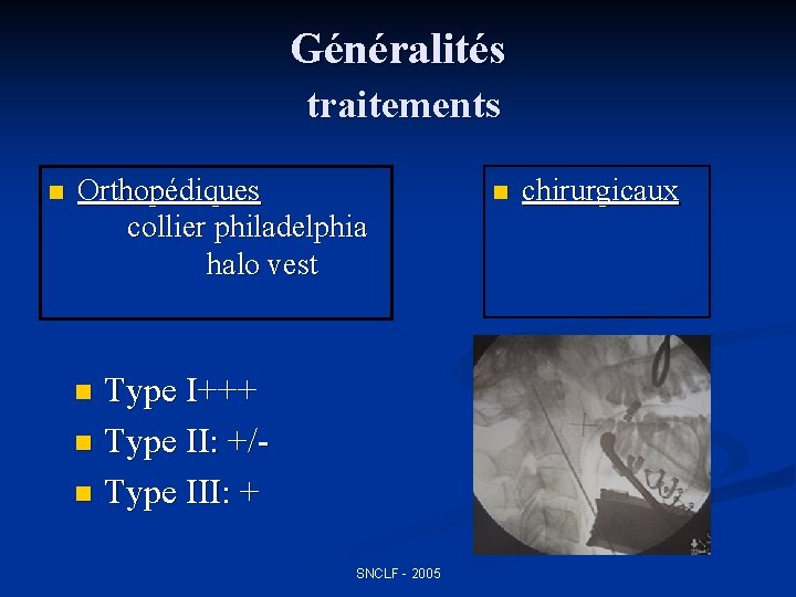 Généralités traitements n Orthopédiques collier philadelphia halo vest Type I+++ n Type II: +/n