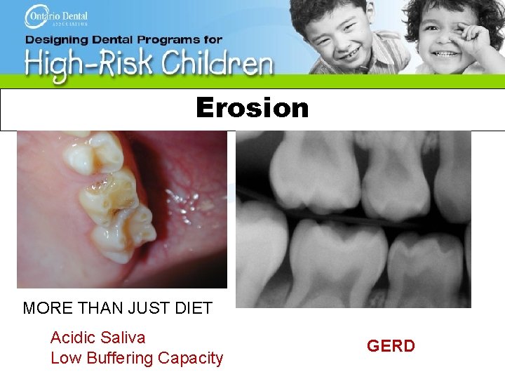 Erosion MORE THAN JUST DIET Acidic Saliva Low Buffering Capacity GERD 