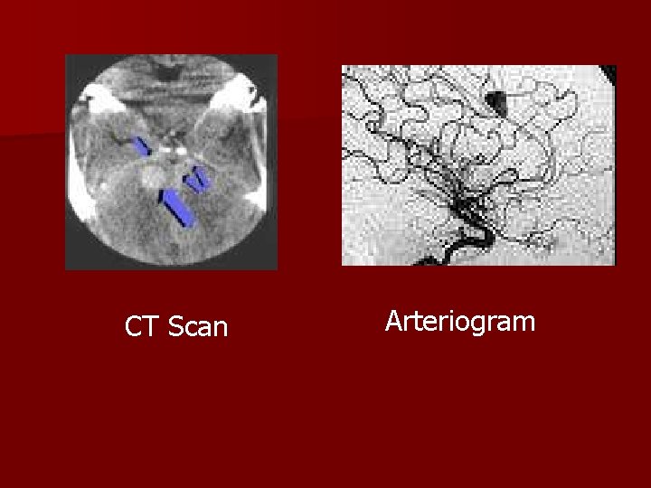 CT Scan Arteriogram 