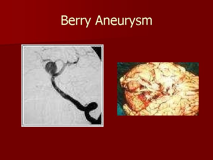 Berry Aneurysm 