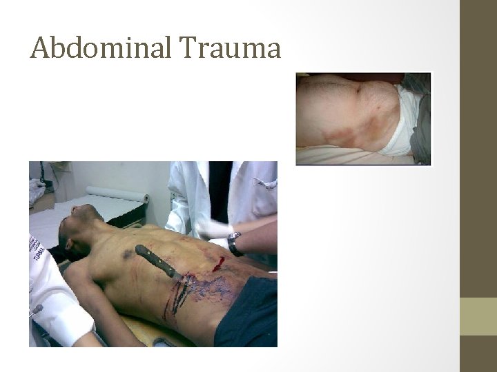 Abdominal Trauma 