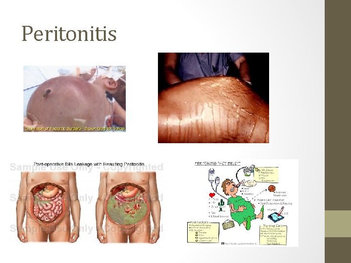 Peritonitis 