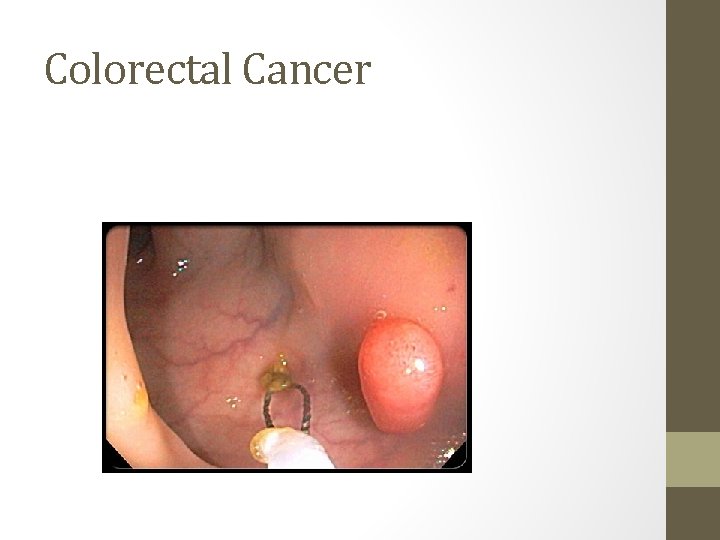 Colorectal Cancer 