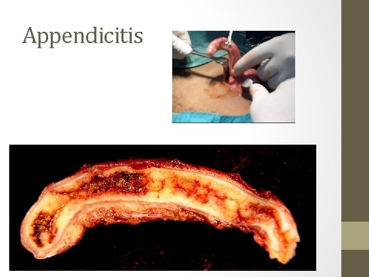 Appendicitis 