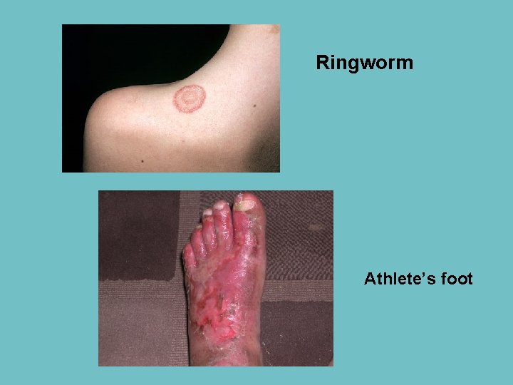 Ringworm Athlete’s foot 