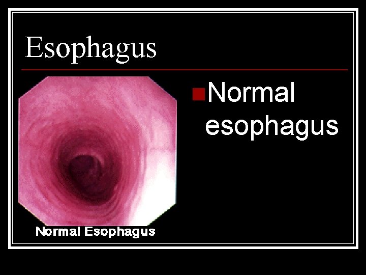 Esophagus n. Normal esophagus 