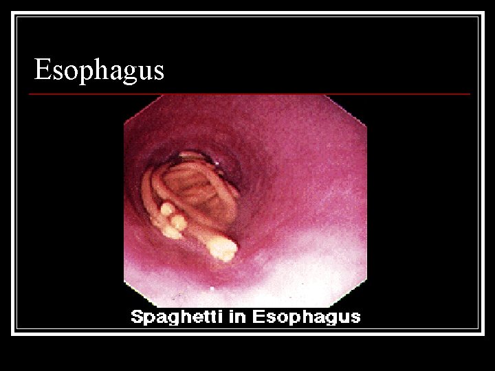 Esophagus 