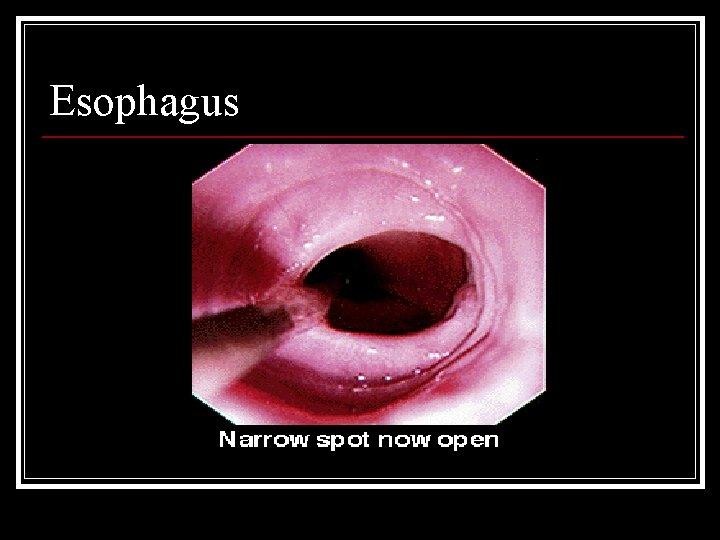 Esophagus 