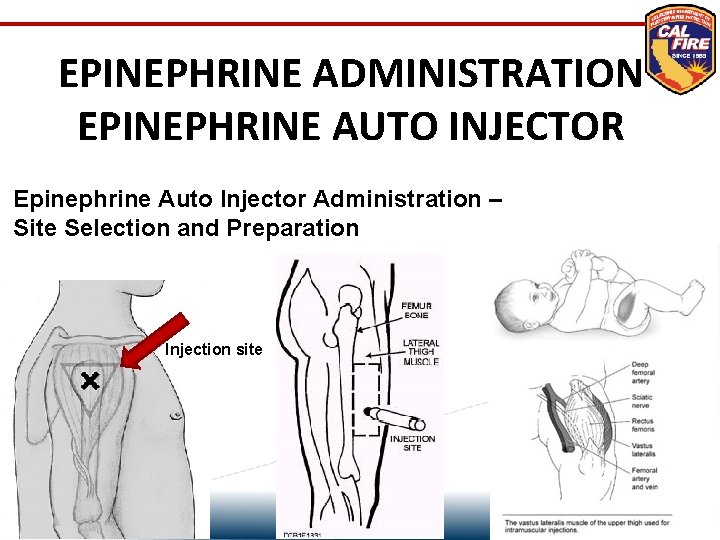 EPINEPHRINE ADMINISTRATION EPINEPHRINE AUTO INJECTOR Epinephrine Auto Injector Administration – Site Selection and Preparation