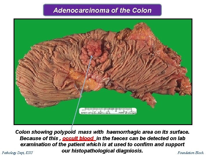 Adenocarcinoma of the Colon showing polypoid mass with haemorrhagic area on its surface. Because Adenocarcinoma of the Colon showing polypoid mass with haemorrhagic area on its surface. Because