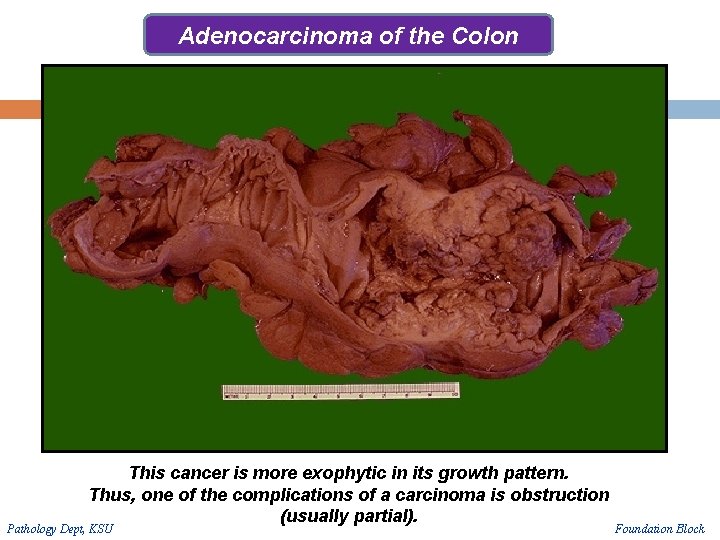 Adenocarcinoma of the Colon This cancer is more exophytic in its growth pattern. Thus, Adenocarcinoma of the Colon This cancer is more exophytic in its growth pattern. Thus,