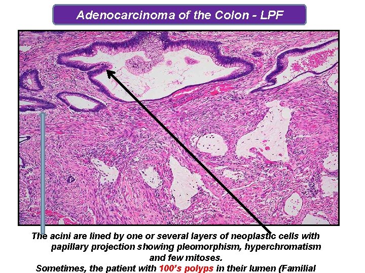 Adenocarcinoma of the Colon - LPF The acini are lined by one or several Adenocarcinoma of the Colon - LPF The acini are lined by one or several