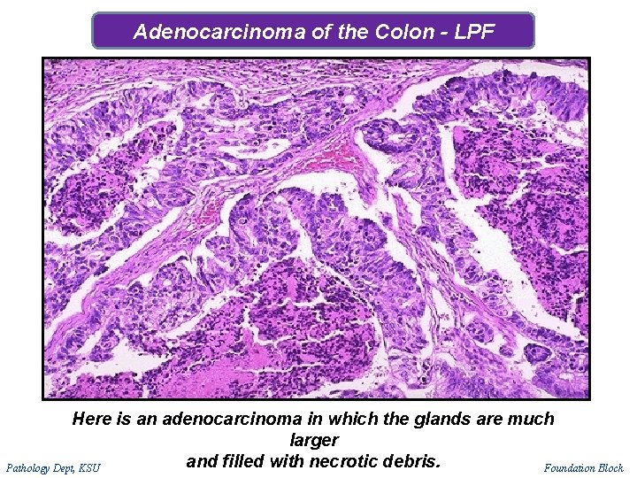 Adenocarcinoma of the Colon - LPF Here is an adenocarcinoma in which the glands Adenocarcinoma of the Colon - LPF Here is an adenocarcinoma in which the glands