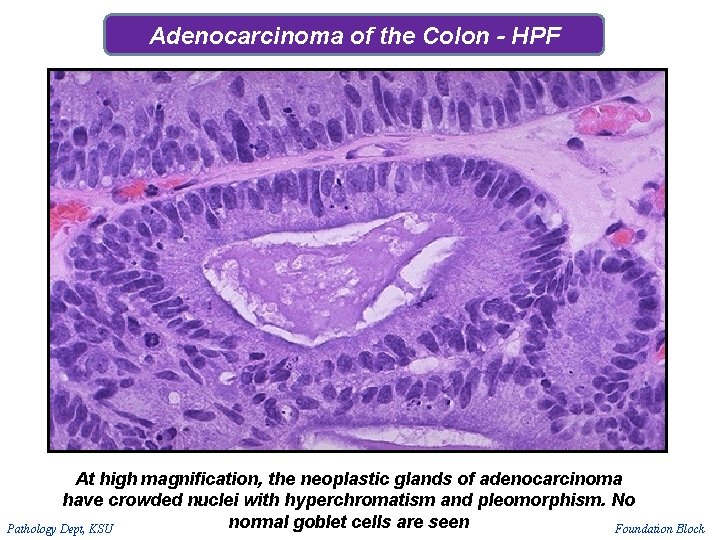 Adenocarcinoma of the Colon - HPF At high magnification, the neoplastic glands of adenocarcinoma Adenocarcinoma of the Colon - HPF At high magnification, the neoplastic glands of adenocarcinoma