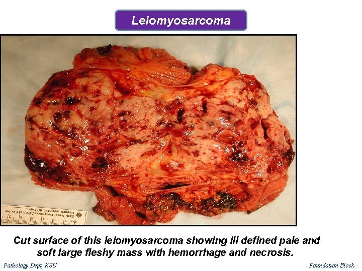Leiomyosarcoma Cut surface of this leiomyosarcoma showing ill defined pale and soft large fleshy Leiomyosarcoma Cut surface of this leiomyosarcoma showing ill defined pale and soft large fleshy