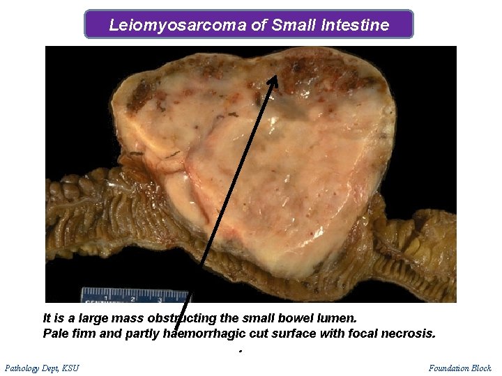 Leiomyosarcoma of Small Intestine It is a large mass obstructing the small bowel lumen. Leiomyosarcoma of Small Intestine It is a large mass obstructing the small bowel lumen.