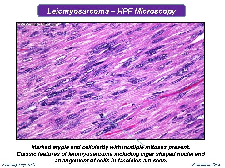 Leiomyosarcoma – HPF Microscopy Marked atypia and cellularity with multiple mitoses present. Classic features Leiomyosarcoma – HPF Microscopy Marked atypia and cellularity with multiple mitoses present. Classic features