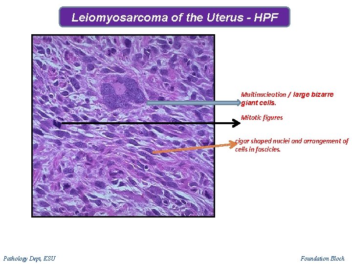 Leiomyosarcoma of the Uterus - HPF Multinucleation / large bizarre giant cells. Mitotic figures Leiomyosarcoma of the Uterus - HPF Multinucleation / large bizarre giant cells. Mitotic figures