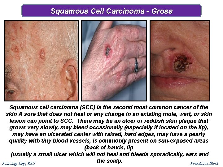Squamous Cell Carcinoma - Gross Squamous cell carcinoma (SCC) is the second most common Squamous Cell Carcinoma - Gross Squamous cell carcinoma (SCC) is the second most common