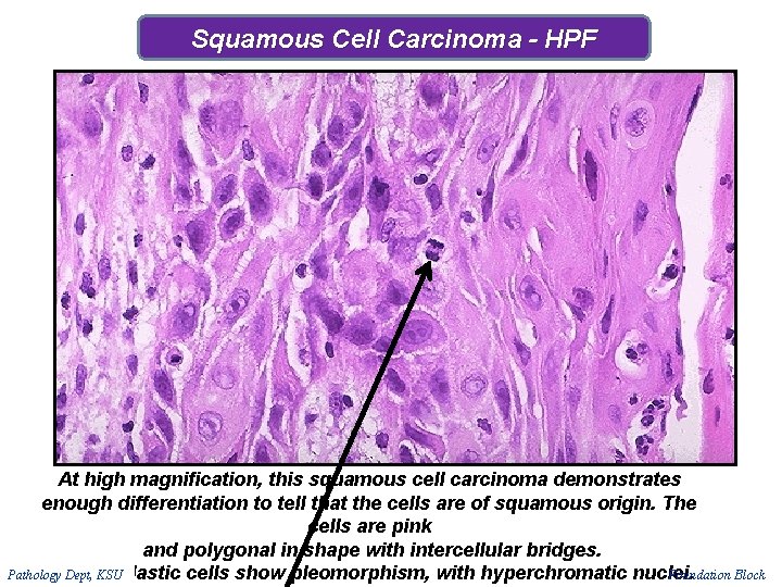 Squamous Cell Carcinoma - HPF At high magnification, this squamous cell carcinoma demonstrates enough Squamous Cell Carcinoma - HPF At high magnification, this squamous cell carcinoma demonstrates enough