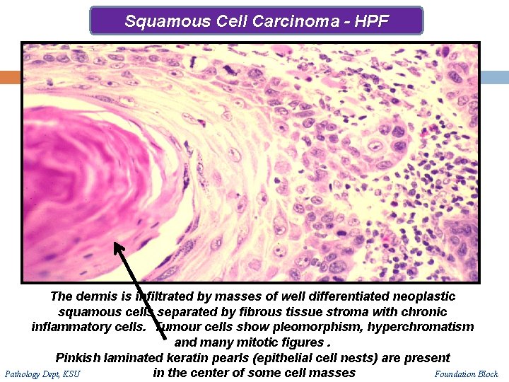 Squamous Cell Carcinoma - HPF The dermis is infiltrated by masses of well differentiated Squamous Cell Carcinoma - HPF The dermis is infiltrated by masses of well differentiated