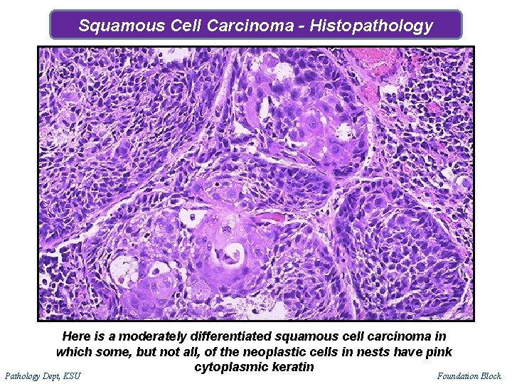 Squamous Cell Carcinoma - Histopathology Here is a moderately differentiated squamous cell carcinoma in Squamous Cell Carcinoma - Histopathology Here is a moderately differentiated squamous cell carcinoma in