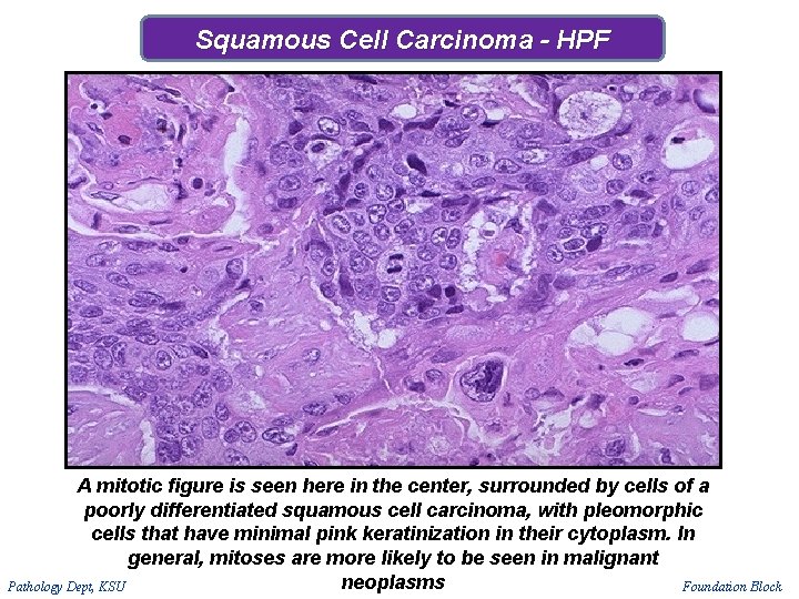 Squamous Cell Carcinoma - HPF A mitotic figure is seen here in the center, Squamous Cell Carcinoma - HPF A mitotic figure is seen here in the center,