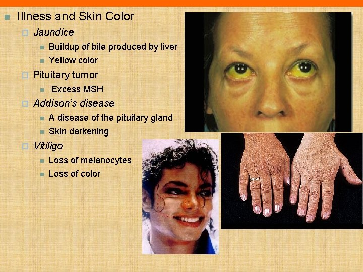 n Illness and Skin Color ¨ Jaundice n n ¨ Pituitary tumor n ¨