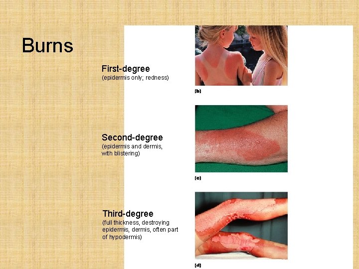 Burns First-degree (epidermis only; redness) Second-degree (epidermis and dermis, with blistering) Third-degree (full thickness,