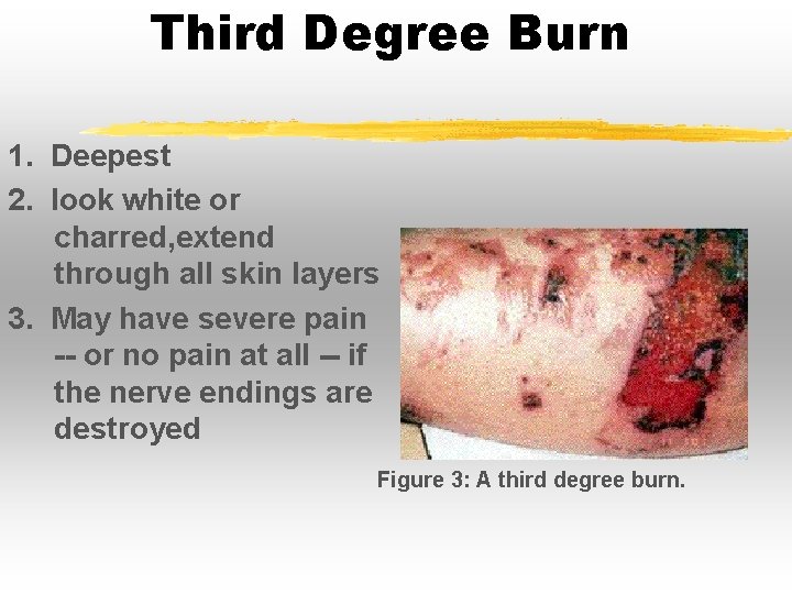 Third Degree Burn 1. Deepest 2. look white or charred, extend through all skin Third Degree Burn 1. Deepest 2. look white or charred, extend through all skin