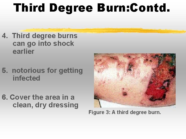 Third Degree Burn: Contd. 4. Third degree burns can go into shock earlier 5. Third Degree Burn: Contd. 4. Third degree burns can go into shock earlier 5.