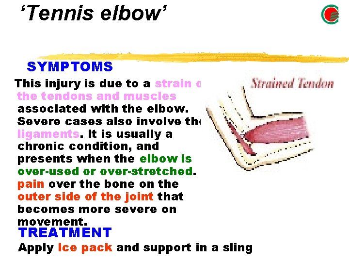 ‘Tennis elbow’ SYMPTOMS This injury is due to a strain of the tendons and ‘Tennis elbow’ SYMPTOMS This injury is due to a strain of the tendons and
