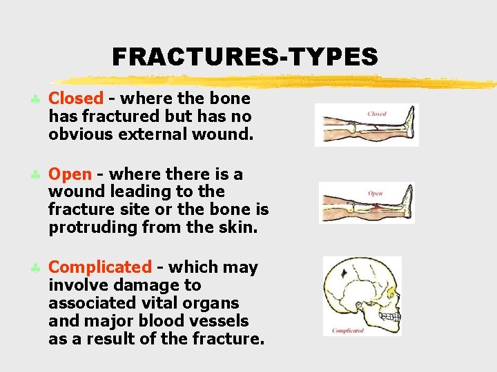 FRACTURES-TYPES § Closed - where the bone has fractured but has no obvious external FRACTURES-TYPES § Closed - where the bone has fractured but has no obvious external
