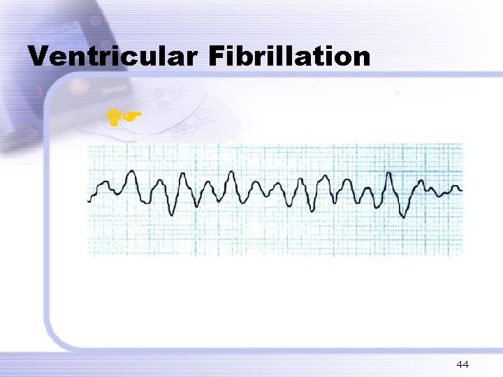 Ventricular Fibrillation VF 44 Ventricular Fibrillation VF 44