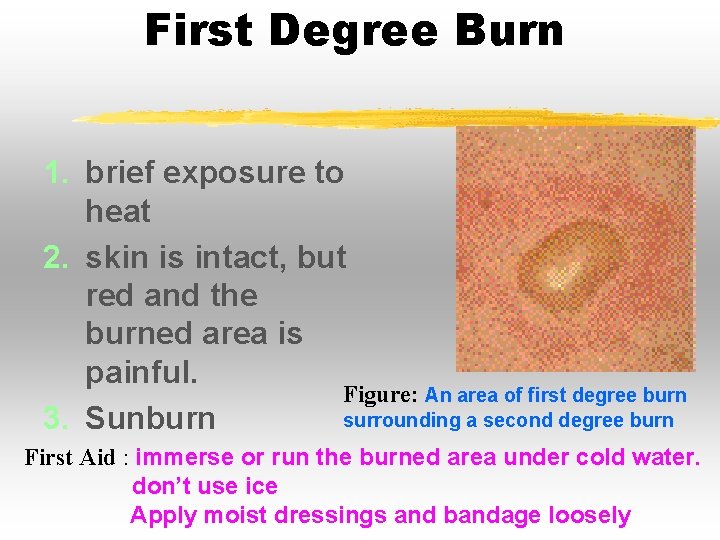 First Degree Burn 1. brief exposure to heat 2. skin is intact, but red First Degree Burn 1. brief exposure to heat 2. skin is intact, but red