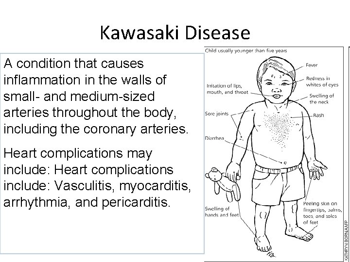 Kawasaki Disease A condition that causes inflammation in the walls of small- and medium-sized