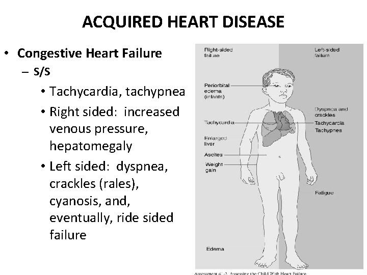 ACQUIRED HEART DISEASE • Congestive Heart Failure – S/S • Tachycardia, tachypnea • Right