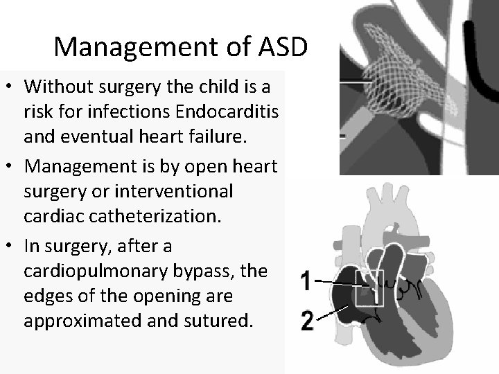 Management of ASD • Without surgery the child is a risk for infections Endocarditis