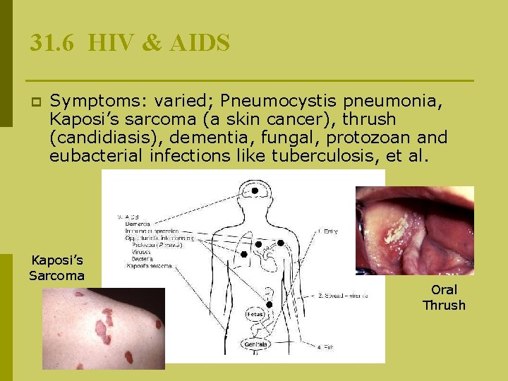 31. 6 HIV & AIDS p Symptoms: varied; Pneumocystis pneumonia, Kaposi’s sarcoma (a skin