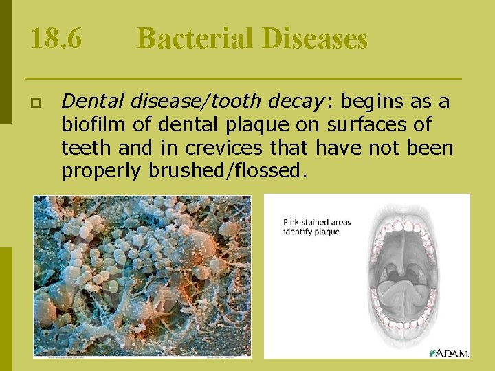 18. 6 p Bacterial Diseases Dental disease/tooth decay: begins as a biofilm of dental
