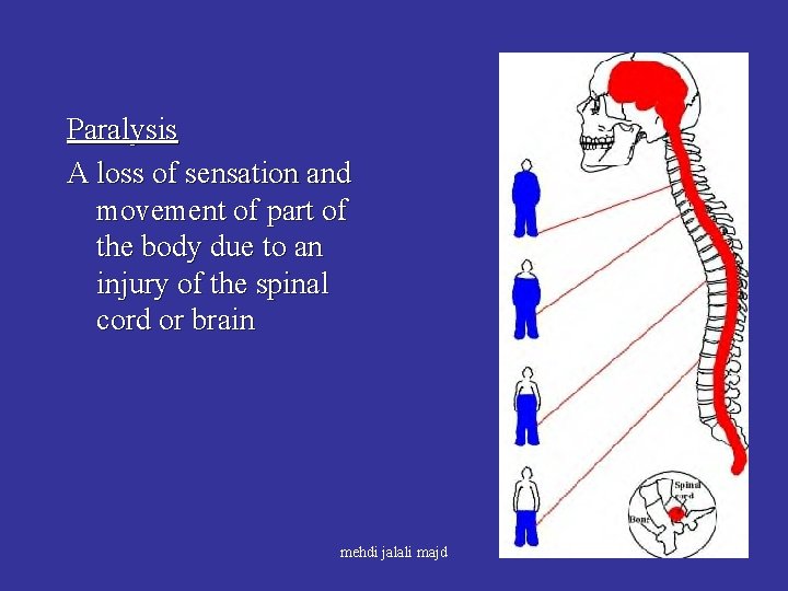 Paralysis A loss of sensation and movement of part of the body due to