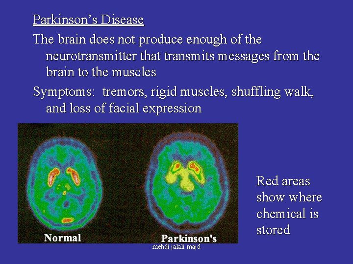 Parkinson’s Disease The brain does not produce enough of the neurotransmitter that transmits messages