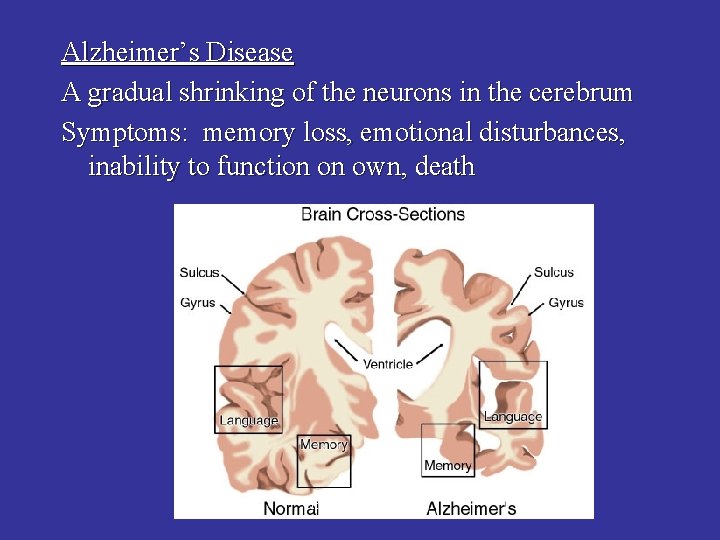 Alzheimer’s Disease A gradual shrinking of the neurons in the cerebrum Symptoms: memory loss,